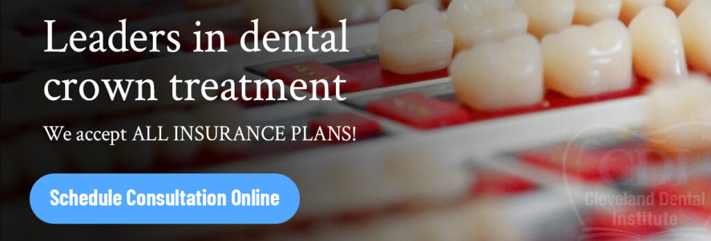 Cleveland Dental Crowns | Tooth Crown | Cleveland Dental Institute