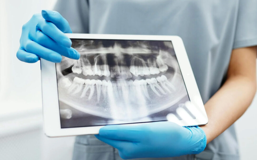 Understanding Root Canals | Cleveland Dental Institute | CDI Ohio