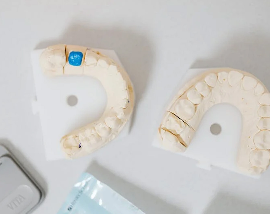 CDI Ohio Dental Office Services | Crowns and Bridges