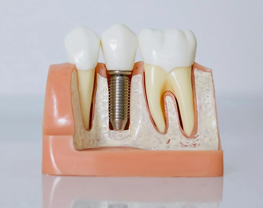 CDI Ohio Dental Office Services | Dental Implants
